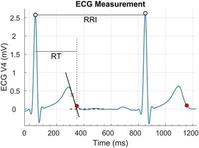 The Effect of Emotional Valence on Ventricular Repolarization Dynamics Is Mediated by Heart Rate Variability: A Study of QT Variability and Music-Induced Emotions